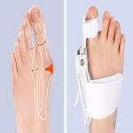 BUFFER® Ayarlanabilir Ayak Baş Parmak Kemik Düzeltici – Halluks Valgus (Bunyon) Aparatı, Gece Gündüz Kullanıma Uygun Ayak Düzeltme Ateli - Görsel 3